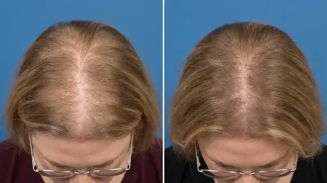 Marilyn T., 62 &mdash; part line, before and after 90 days